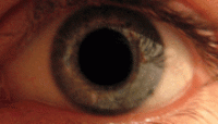 Eye Dilate Thumb 180px